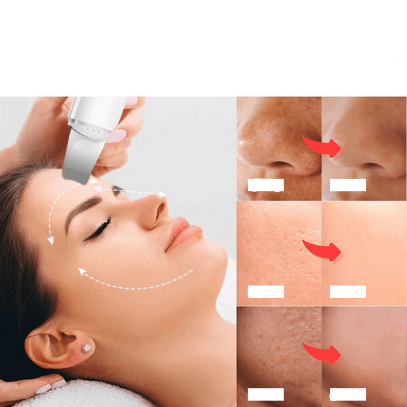 Esfoliante Ultrassônico de Pele: Removedor de Cravos e Limpador Facial com Cavitação 